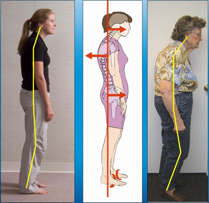  at your posture from the side, you have forward head posture (FHP).
